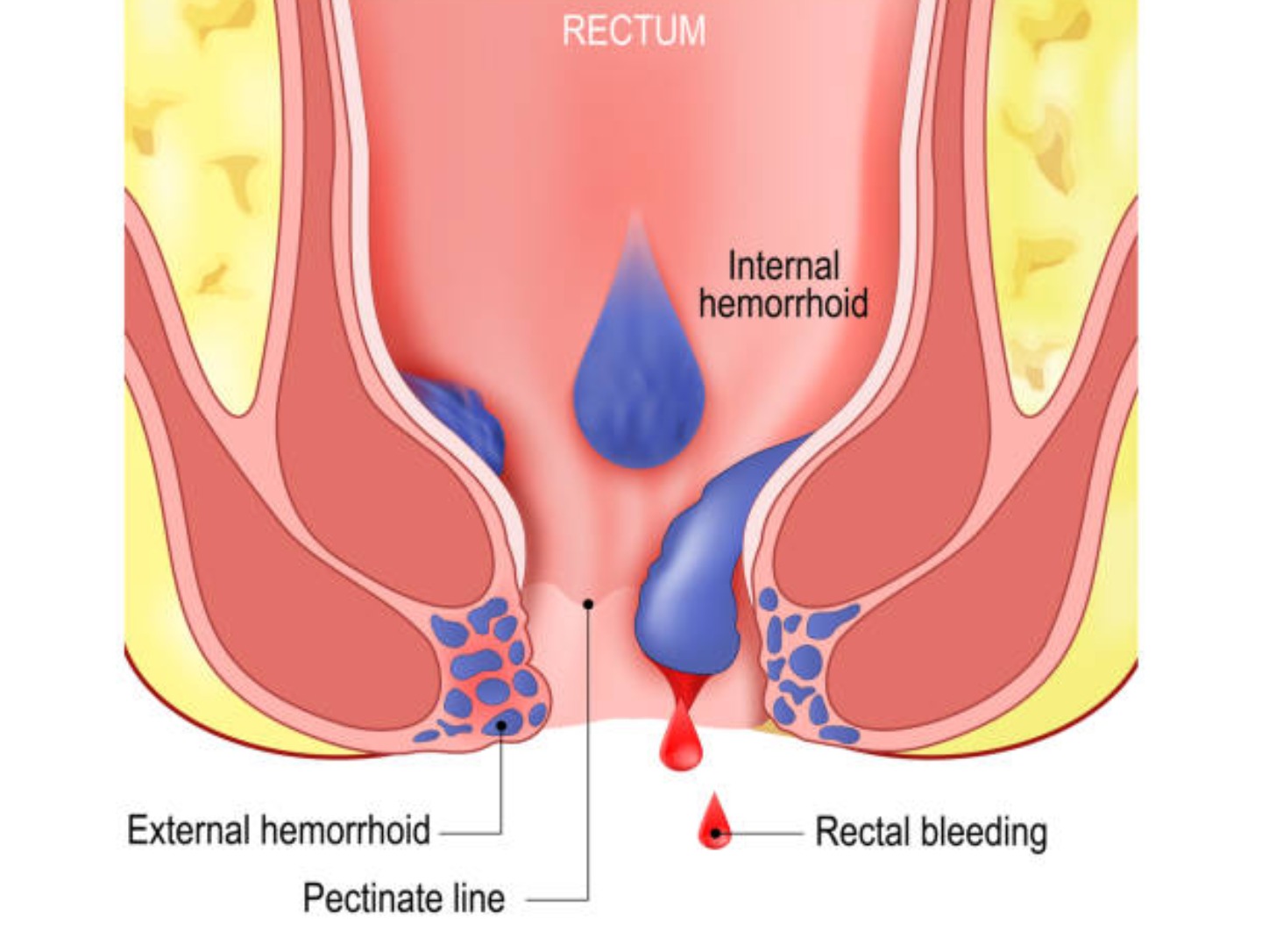 Medical illustration representing piles symptoms